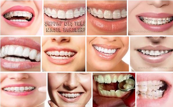 şeffaf diş teli İstanbul Diş Eti Hastalıkları Uzmanı