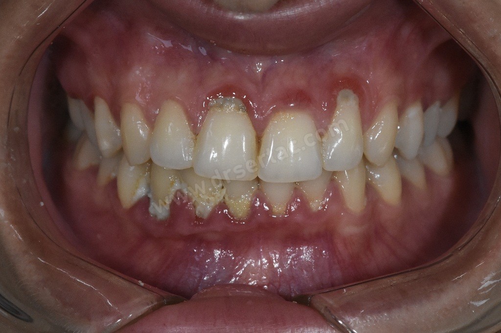 diş eti hastalığı tedavisi İstanbul Diş Eti Hastalıkları Uzmanı